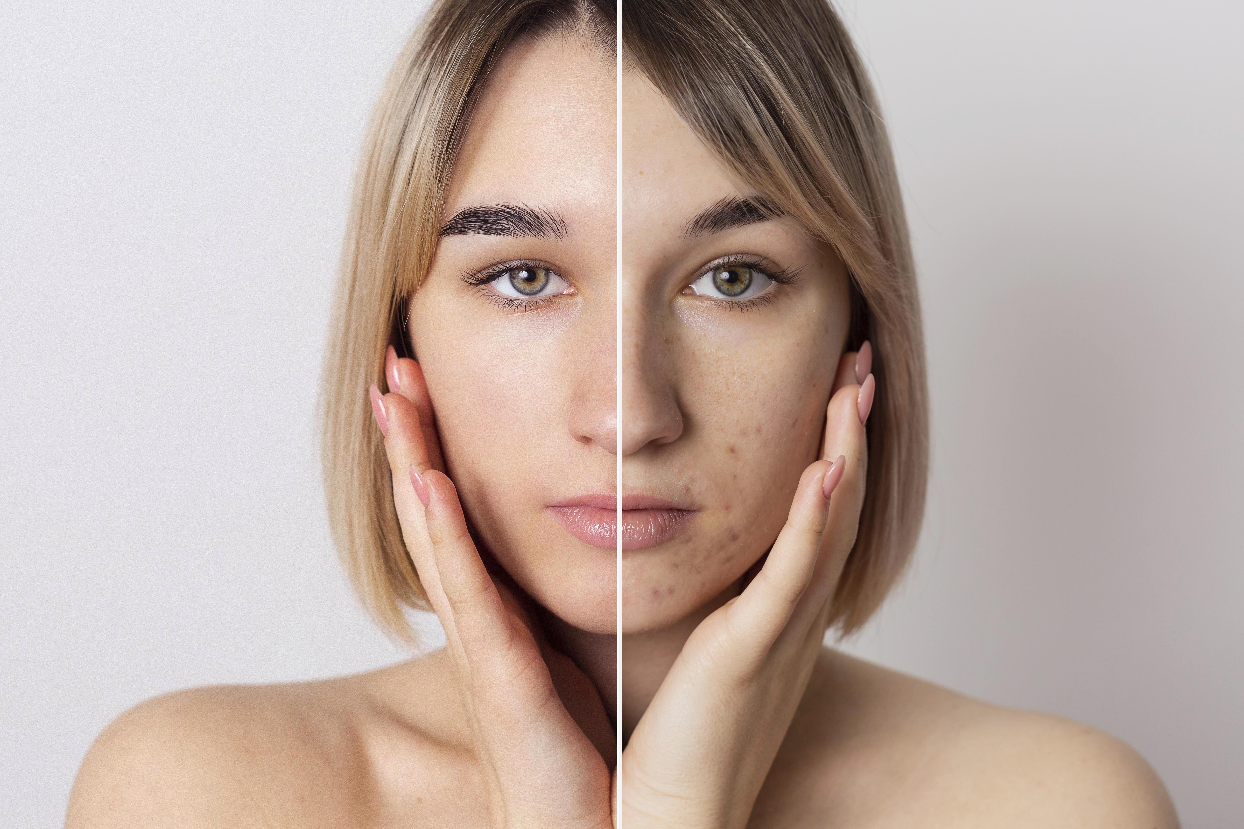 Anti Acne Supplement